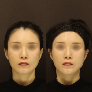 新宿で頬ヒアルロン酸ボリフトの効果と料金｜30代女性のリフトアップ体験の症例写真