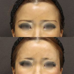 【額ヒアルロン酸】丸み曲線で横顔美人｜50代女性 ボライト【東京】の症例写真