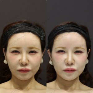 【額ヒアルロン酸】丸いおでこで横顔美人｜40代女性 ボリューマ【代々木】の症例写真