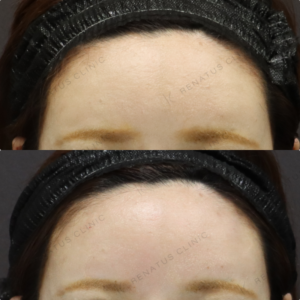 【額ヒアルロン酸】丸いおでこで横顔美人｜40代女性 ボリューマ【代々木】の症例写真