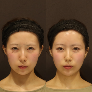 新宿のヒアルロン酸注射で上手い｜ボリフトで額・こめかみを自然に整えた20代女性の記録の症例写真