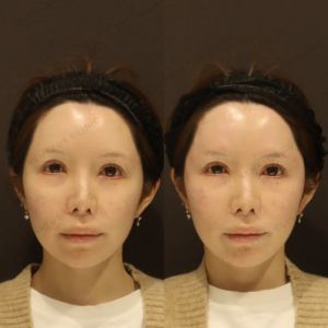 新宿のヒアルロン酸注射が上手いクリニック｜ボリフトで額・こめかみを自然に整えた30代女性の記録の症例写真