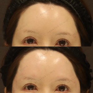 新宿のヒアルロン酸注射が上手い｜ボリフトで額・こめかみを自然に整えた30代女性の記録の症例写真