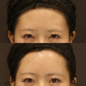 新宿のヒアルロン酸注射が上手い｜ボリフトで額・こめかみを自然に整えた20代女性の記録の症例写真