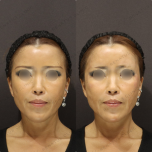 額・頬ボライトヒアルロン酸症例写真の症例写真