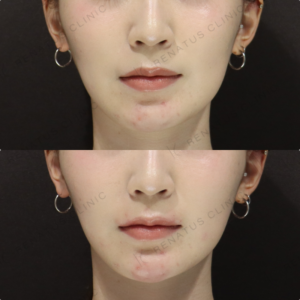 【顎ヒアルロン酸】前方投影で横顔強化｜20代女性【東京】の症例写真