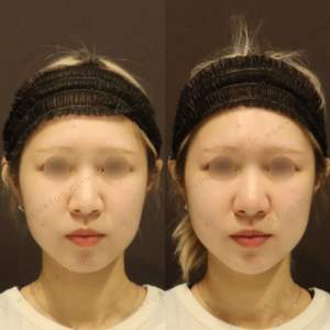 新宿で顎ヒアルロン酸注入が上手い｜ダイヤモンドフィール使用・20代女性の症例写真