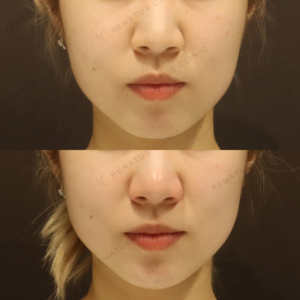 新宿の顎ヒアルロン酸が上手いクリニック｜20代女性・ダイヤモンドフィール使用の症例写真