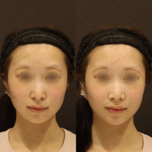 新宿で顎ヒアルロン酸注入が上手い｜20代女性・ダイヤモンドフィール使用の症例写真