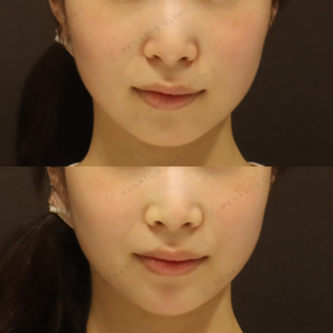 新宿で顎ヒアルロン酸が上手いクリニック｜ピネハで小顔を叶えた女性の記録の症例写真