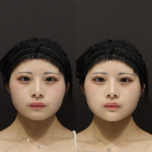 【顎ヒアルロン酸】シャープな輪郭形成｜10代女性 【新宿】の症例写真