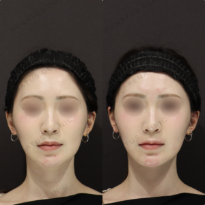 【顎ヒアルロン酸】Vライン形成で小顔見せ｜20代女性 ダイヤモンドフィール【新宿】の症例写真