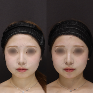 【顎ヒアルロン酸】Vライン補正で小顔印象｜20代女性 【渋谷区】の症例写真