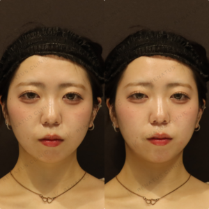 新宿の顎ヒアルロン酸注入が上手いクリニック｜ピネハ使用・20代女性の施術記録の症例写真