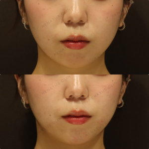 新宿の顎ヒアルロン酸注入が上手い｜ピネハで小顔を叶えた20代女性の記録の症例写真