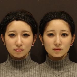 新宿の顎ヒアルロン酸注入が上手い｜ピネハで20代女性が自然な小顔にの症例写真