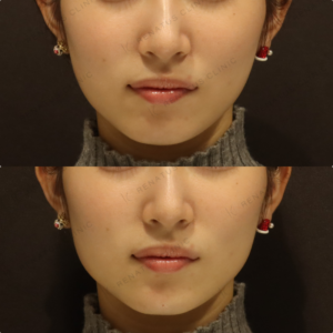 新宿の顎ヒアルロン酸が上手い｜ピネハで小顔を叶えた20代女性の症例写真