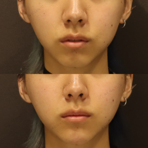 新宿のヒアルロン酸注射（顎）が上手い｜ボラックス使用・20代男性の施術の症例写真