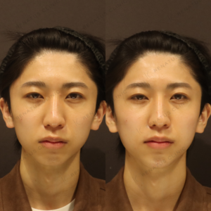 新宿の顎ヒアルロン酸で上手い｜ピネハで整えた10代男性の仕上がりの症例写真