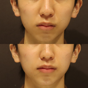 新宿のヒアルロン酸注入（顎）が上手いクリニック｜ダイヤモンドフィール使用・10代男性症例の症例写真