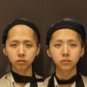 新宿のヒアルロン酸注射（顎）が上手い｜ボラックス使用・20代男性の症例写真