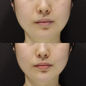 【顎ヒアルロン酸】顎先の高さ・長さ微調整｜20代女性 ボラック【代々木】の症例写真