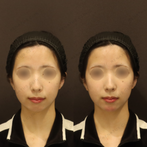 新宿のヒアルロン酸顎形成が上手い｜ボラックス使用・20代女性の施術例の症例写真