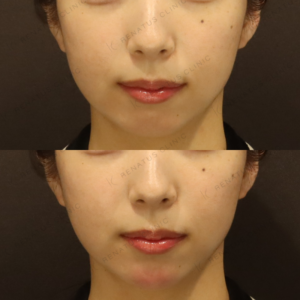 新宿のヒアルロン酸注射（顎）が上手い｜ボラックス使用・20代女性の症例の症例写真