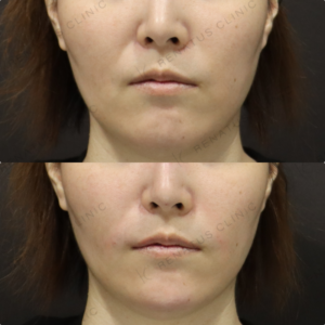 【顎ヒアルロン酸】Vライン形成で小顔見せ｜30代女性 ボラックス【新宿】の症例写真