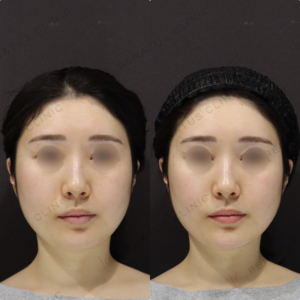 【顎ヒアルロン酸】シャープな輪郭形成｜20代女性 ボラックス【東京】の症例写真