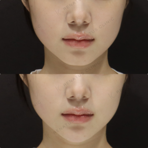 【顎ヒアルロン酸】顎先を整えて美しいフェイスライン｜20代女性 ボラックス【代々木】の症例写真