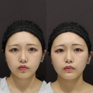 【顎ヒアルロン酸】Eライン整えて輪郭改善｜20代女性 ボラックス【東京】の症例写真