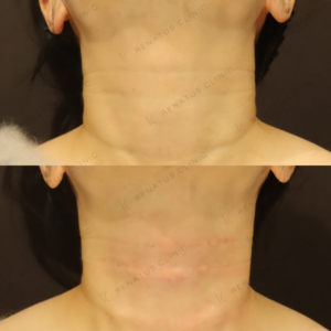 新宿のボライト注射で上手いクリニック｜40代女性の首のハリ改善の症例写真