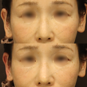 新宿の鼻ヒアルロン酸注射が上手い｜ボラックスで自然な高さを叶えた50代女性の記録の症例写真