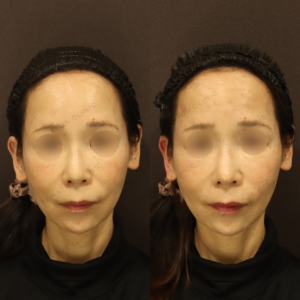 新宿のヒアルロン酸注射が上手い｜ボラックスで50代女性の鼻・ほうれい線を自然に整えた症例の症例写真