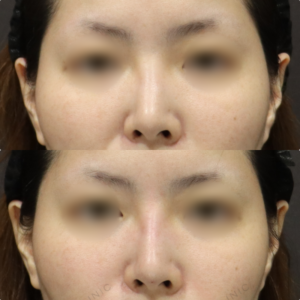 【鼻ヒアルロン酸】鼻根部の高さで横顔改善｜30代女性ボラックス【東京】の症例写真