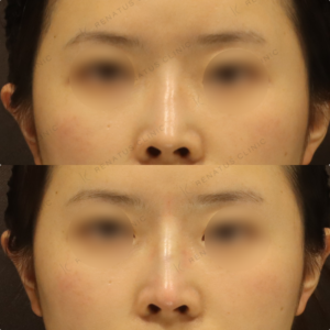 新宿で鼻ヒアルロン酸が上手いクリニック｜ボラックスで30代女性が実感した効果と料金の症例写真