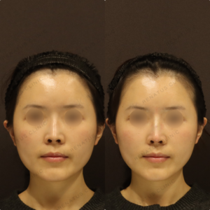 新宿で鼻ヒアルロン酸が上手いクリニック｜30代女性がボラックス（VOLUX）で叶えた自然な高鼻の症例写真