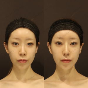 新宿で鼻ヒアルロン酸が上手いクリニック｜ボラックス使用・20代女性の効果と料金の症例写真