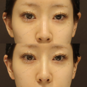 新宿で鼻ヒアルロン酸が上手いクリニック｜20代女性がボラックスで美鼻を叶えたの症例写真