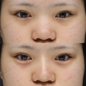 新宿のヒアルロン酸注射が上手い｜ボルベラで涙袋・鼻を自然に整えた10代女性の記録の症例写真