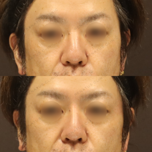 新宿の鼻ヒアルロン酸｜40代男性がボラックスで鼻筋を整えた効果と料金の症例写真