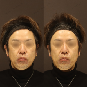 新宿の鼻ヒアルロン酸（ボラックス）40代男性の効果と料金相場の症例写真