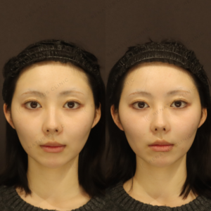 新宿の鼻翼基部ヒアルロン酸注射が上手いと評判｜ボリューマ使用・20代女性の症例写真