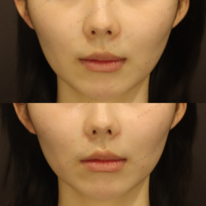 新宿の鼻翼基部フィラーで上手い｜ボリューマで整えた30代女性の仕上がりの症例写真
