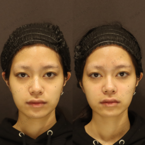 新宿の鼻翼基部ヒアルロン酸注射が上手いクリニック｜ボリューマで自然に整えた20代女性の事例の症例写真