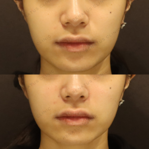 新宿の鼻翼基部フィラーが上手いクリニック｜ボリューマで整えた20代女性の鼻元の症例写真