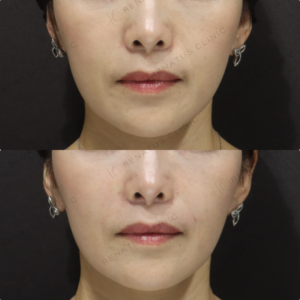 新宿のヒアルロン酸注射が上手いクリニック｜40代女性のほうれい線・鼻翼基部にボリフトの症例写真