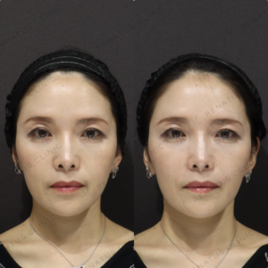 新宿のヒアルロン酸注射が上手い｜ボリフトでほうれい線を改善した40代女性の症例写真