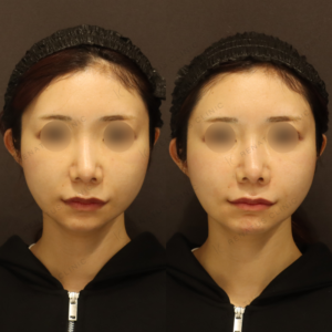 新宿のヒアルロン酸注射が上手い｜30代女性のほうれい線・鼻翼基部にボリフトの症例写真